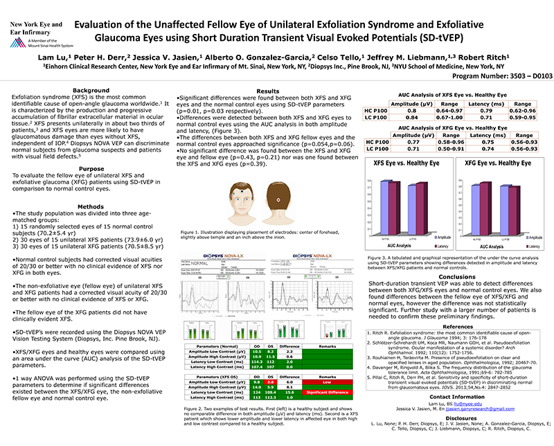 Evaluation of the Unaffected Fellow Eye of Unilateral Exfoliation Syndrome and Exfoliative Glaucoma Eyes using SD-tVEP