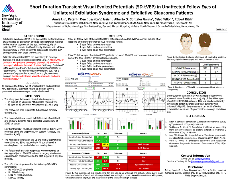 SD-tVEP in Unaffected Fellow Eyes of Unilateral Exfoliation Syndrome and Exfoliative Glaucoma Patients ARVO 2015